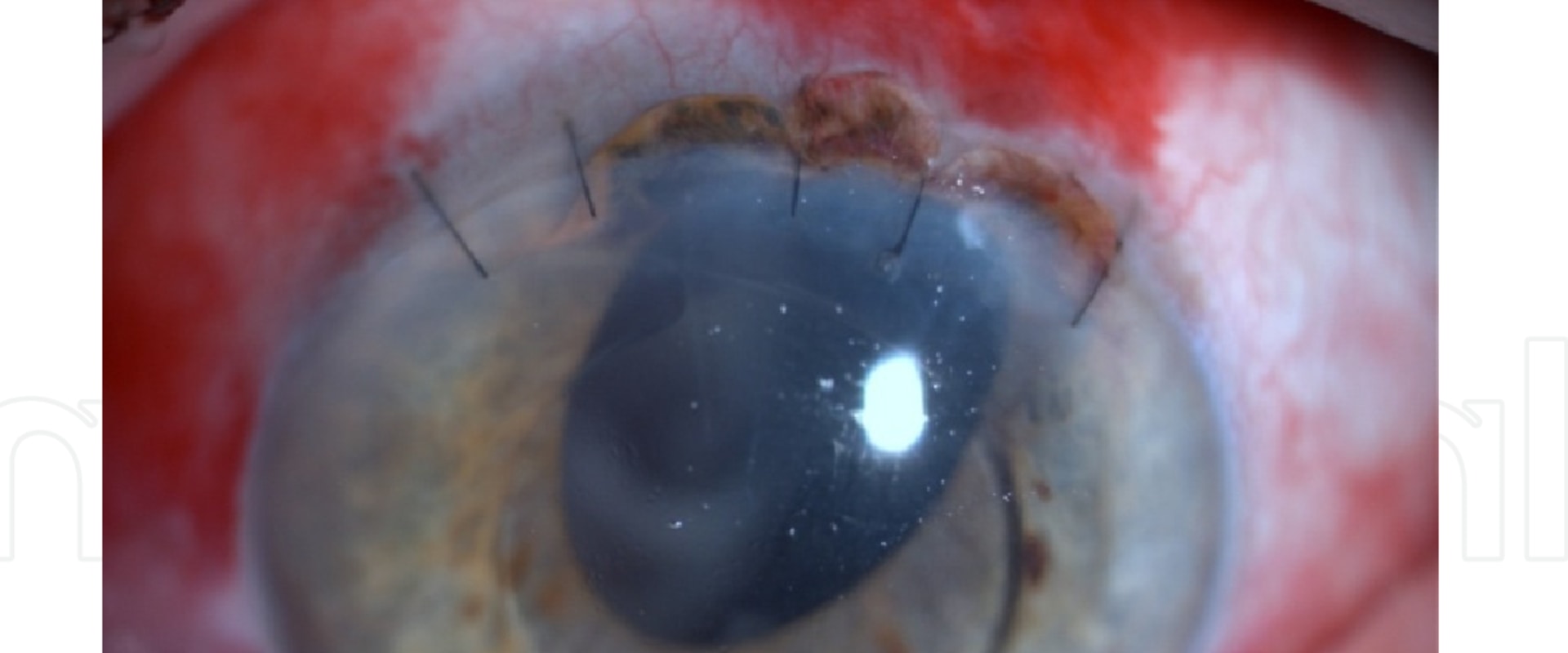 What are the Possible Complications of Cataract Surgery? A Comprehensive Guide