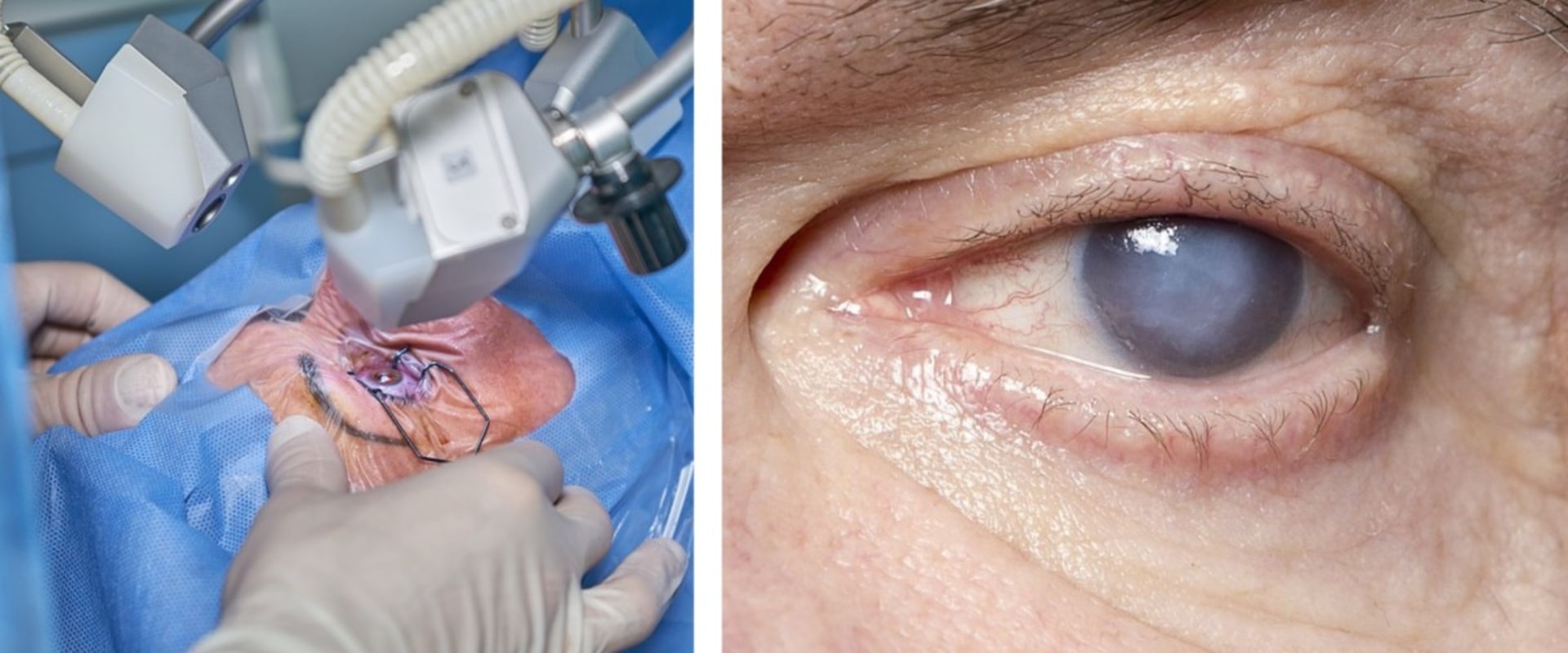 Everything You Need to Know About Cataract Surgery