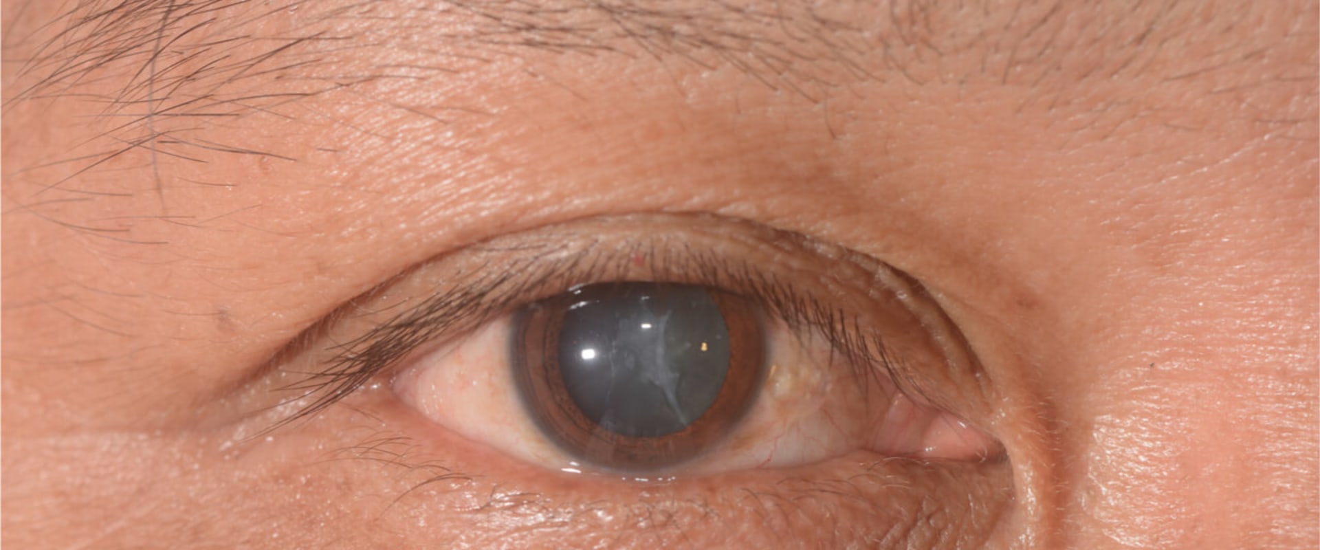 What is the Typical Vision After Cataract Surgery?