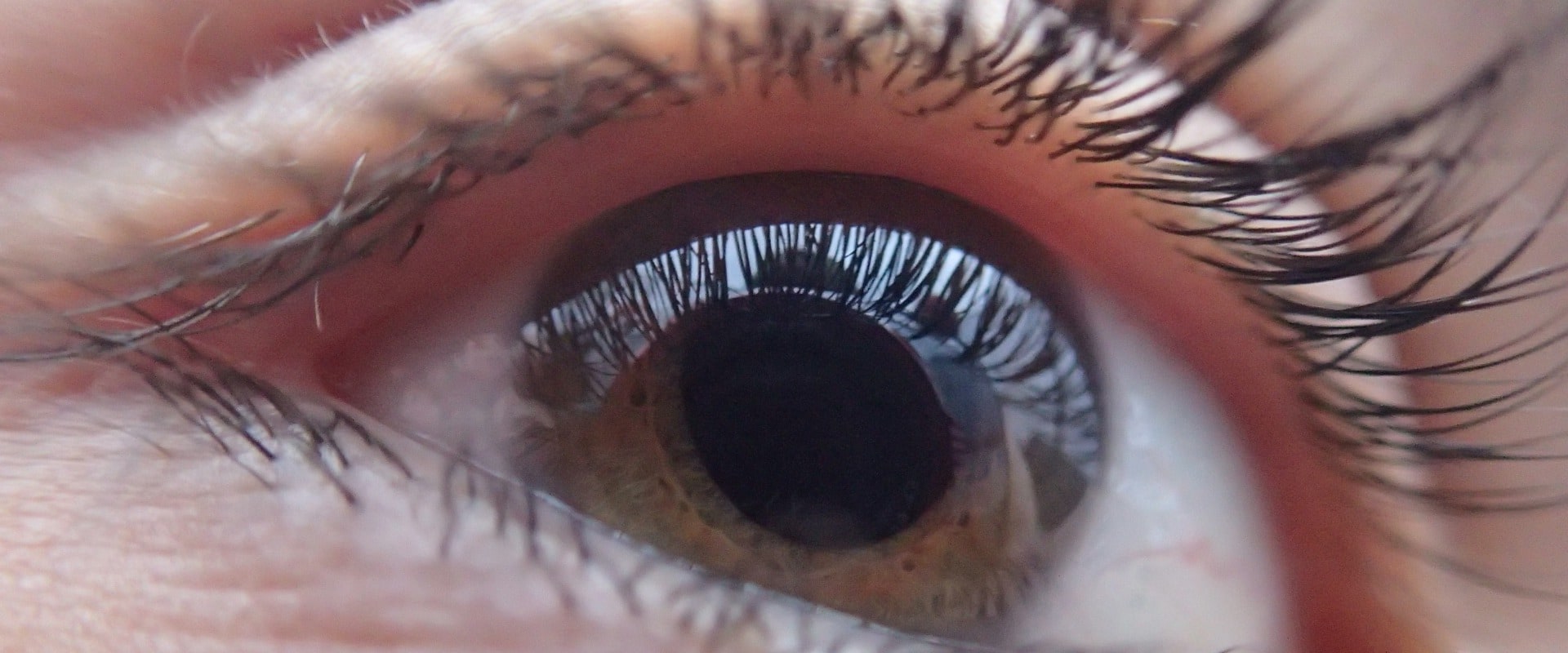 Understanding Vision Changes After Cataract Surgery