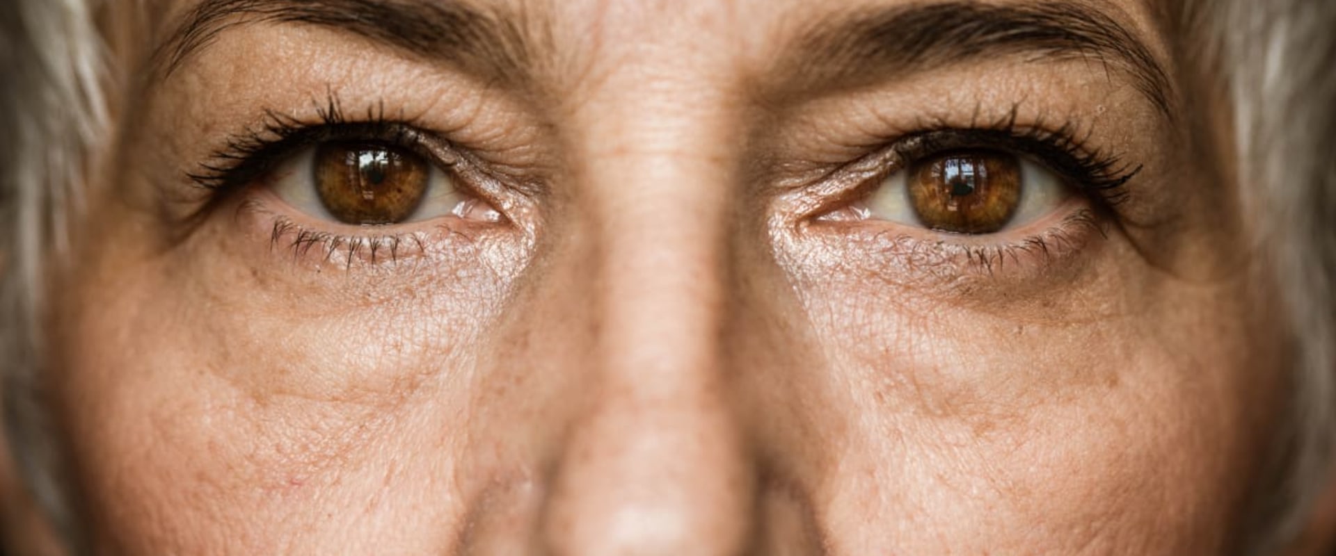 Will Cataract Surgery Improve My Vision? - An Expert's Perspective