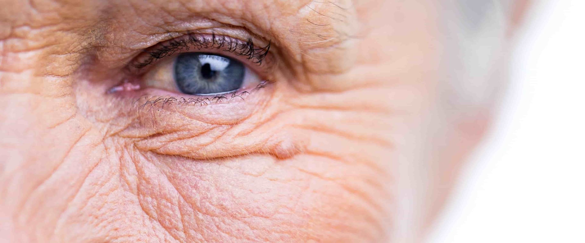 Recovering from Cataract Surgery: What to Expect