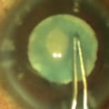 What Causes Fluctuating Vision After Cataract Surgery?
