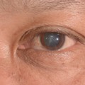 What is the Typical Vision After Cataract Surgery?