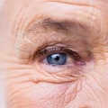 Recovering from Cataract Surgery: What to Expect