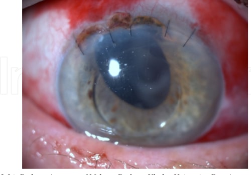 What are the Possible Complications of Cataract Surgery? A Comprehensive Guide