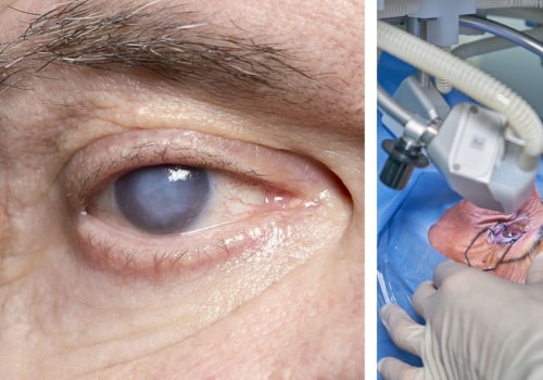 Everything You Need to Know About Cataract Surgery