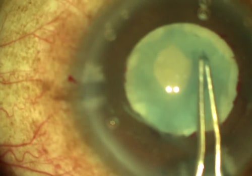 What Causes Fluctuating Vision After Cataract Surgery?