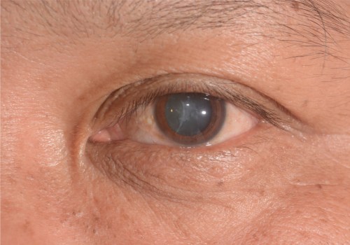 What is the Typical Vision After Cataract Surgery?